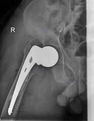 Partial Hip Replacement/Hip hemiarthroplasty is an orthopaedic procedure radiograph