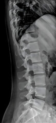 lateral radiograph of the lumbar spine provides a side view of the five lumbar vertebrae (L1-L5) and the surrounding structures.