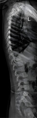 lateral radiograph of the thoracic and lumbar spine in a child provides a side view of the vertebral column, including the thoracic and lumbar vertebrae, as well as the surrounding soft tissues.