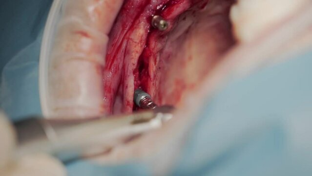 Installation of a bridge prosthesis.