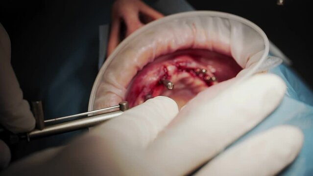 Installation of a bridge prosthesis.