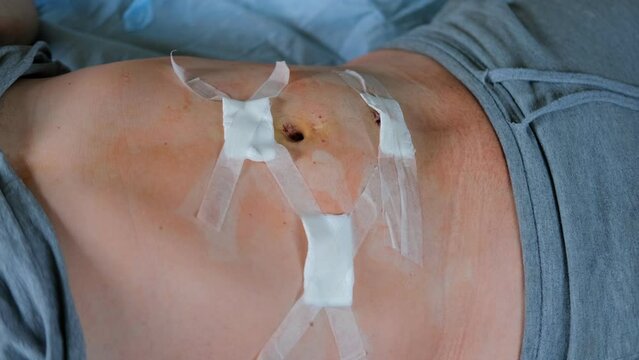 Hands of medic or nurse in blue gloves examining a fresh suture on a male stomach after laparoscopy surgical removal of appendicitis. Doctor examines of the patient. Man belly with medical stitches