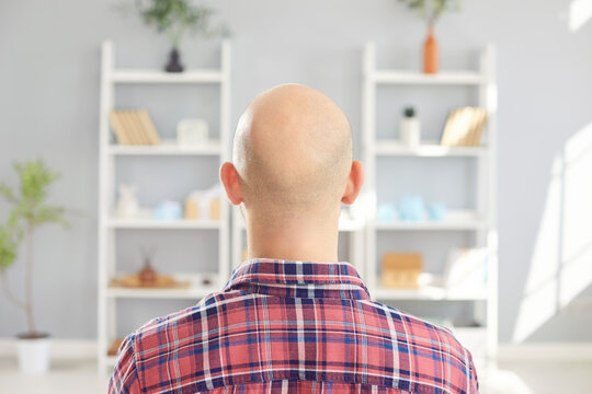 Backside view shot showing the head of a bald man. This image captures baldness or hair loss, highlighting the medical care and attention to head skin health associated with alopecia.