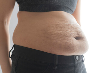 Postnatal changes as stretches on skin. After birth marks on belly of woman. 