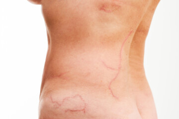 Picture female body skin burned skin burned by jellyfish portuguese man o' war