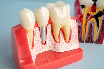 Dental implant, artificial tooth roots into jaw, root canal of dental treatment, gum disease, teeth...