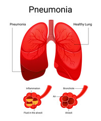 Diagram of pneumonia and healthy lungs