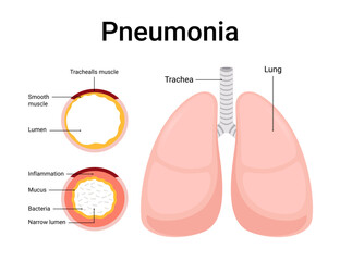 Pneumonia diagram design for medical