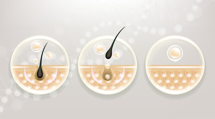 Hyaluronic acid before and after hair removal and skin solutions ad. white collagen serum drop into skin cells with cosmetic advertising background ready to use, illustration vector.