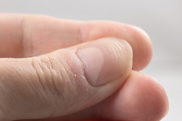 Ridged fingernail of a thumb finger of a man with horizontal ridges on white background.