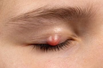 Chalazion on the eyelid of a girl close-up