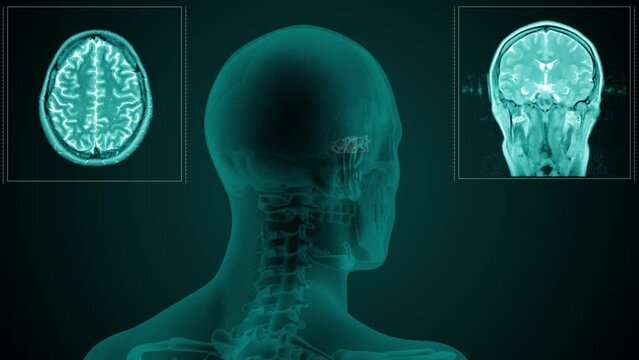 Magnetic resonance scan of the head of a man with visible paranasal Ethmoid air cells. Anatomically correct 3d animation on dark background