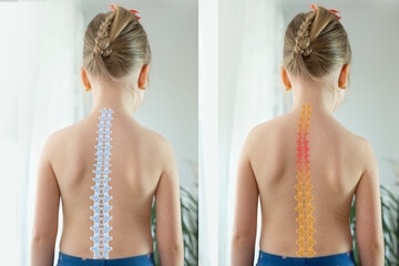 child, young girl showcasing Normal healthy spine and curved spine with scoliosis, need medical...