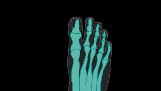 X-ray, roentgen sample animation. Top foot x ray big toe symptom structure. Orthopedic patients surgery film. Foot bones, joint deformity feet, anatomy. Illustration medical video