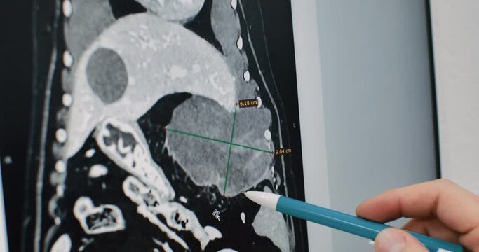 Close-up of an MRI image of an animal A veterinarian's hand shows a tumor lesion on an MRI image on a computer monitor. The doctor conducts a consultation based on the results of the MRI examination.