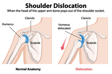 Comparison of normal and dislocated shoulder anatomy