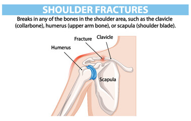 Diagram of shoulder fractures and affected bones