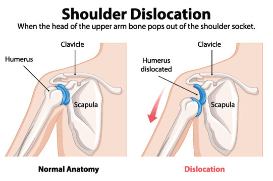 Comparison of normal and dislocated shoulder anatomy