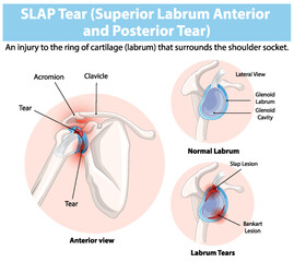 Detailed diagram of shoulder labrum tears
