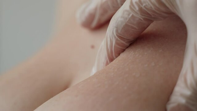 Close-up of dermatological examination of patient with blistering rash by doctor wearing gloves. Reaction of delicate and sensitive skin to cosmic irritants. Dermatological skin disease.