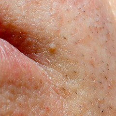 Fototapeta premium fibroma or papilloma on the skin of an adult