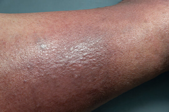 Medical themes: Female senior patient with skin changes caused by venous stasis. Sclerodermiforms