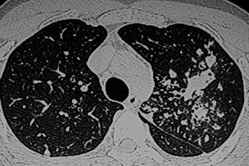CAT Scan of patient  with tuberculosis infection on left lung.