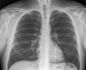 Chest radiograph with broken rib cage and shoulder dislocation injury