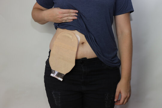 Woman showing the colostomy in the abdomen in a white background. Caucasian woman with colostomy 