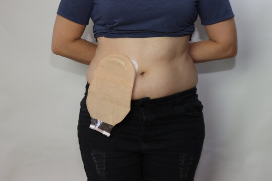 Woman showing the colostomy in the abdomen in a white background. Caucasian woman with colostomy 