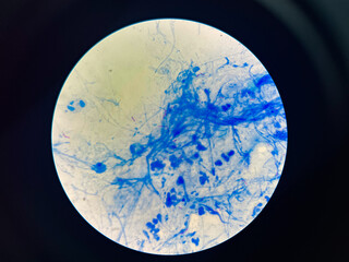 AFB 3+ sample collect sputum.