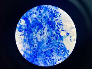 AFB 3+ sample collect sputum.