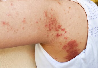 Portrait showing the rash hives allergy and inflammation skin, reaction and urticaria, urticaria...