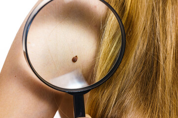 Closeup brown mole on skin.