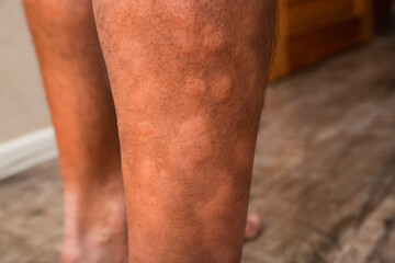 Male feet skin allergic reaction to fever.  Urticaria vasculitis disease causes itchy wheals. ...