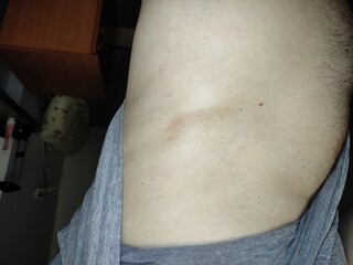 Bruise on the skin on the side of the body