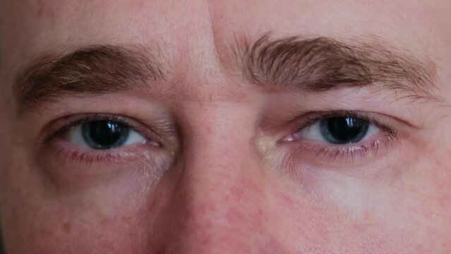 Close-up of a man's gray eyes with dilated big pupils. Eye drops for a visit to an ophthalmologist. Ophthalmological examination and treatment.
