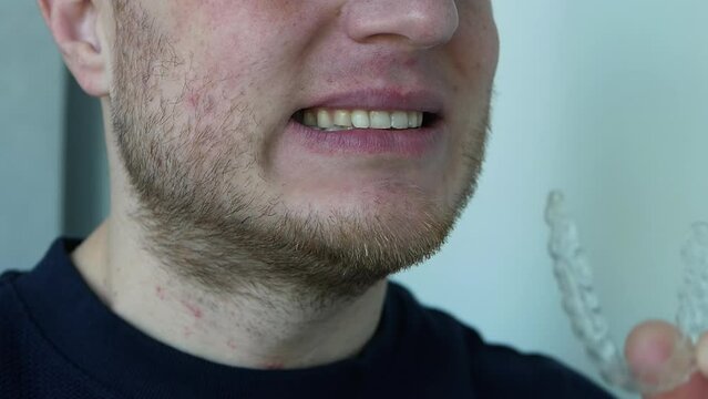 Place the aligner on your teeth. A man with a mouthguard in his teeth. Transparent protector for teeth against broken fillings. Jaw alignment.