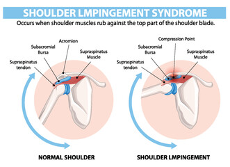 Comparison of normal shoulder and shoulder impingement