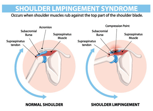 Comparison of normal shoulder and shoulder impingement