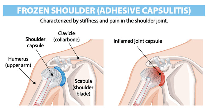 Diagram showing frozen shoulder anatomy and inflammation