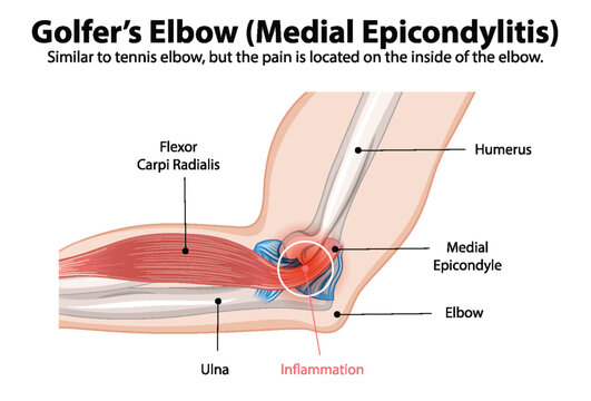 Golfers Elbow Images – Browse 382 Stock Photos, Vectors, and Video | Adobe Stock