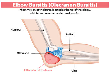 Inflammation of the elbow bursa causing pain