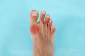 Inflammation of joints of feet and legs of Asian young man. Concept of joint pain, gout, injury,...