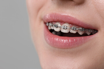 Obraz premium Smiling woman with dental braces on grey background, closeup