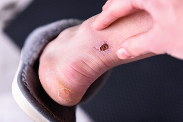 Woman's hand holding feet with infected wound, healing process.