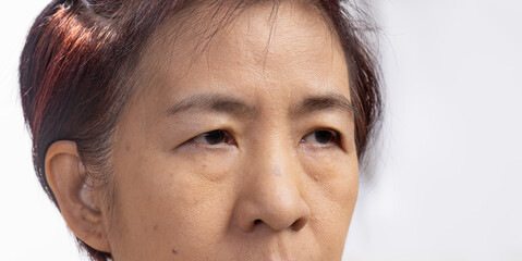 The ptosis or droopy eyelids in asian senior woman.