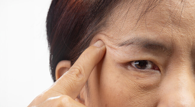 The ptosis or droopy eyelids in asian senior woman.