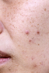 Obraz premium Inflamed acne that appears on a woman's face