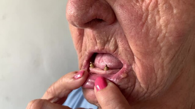 toothless elderly woman showing implant screws